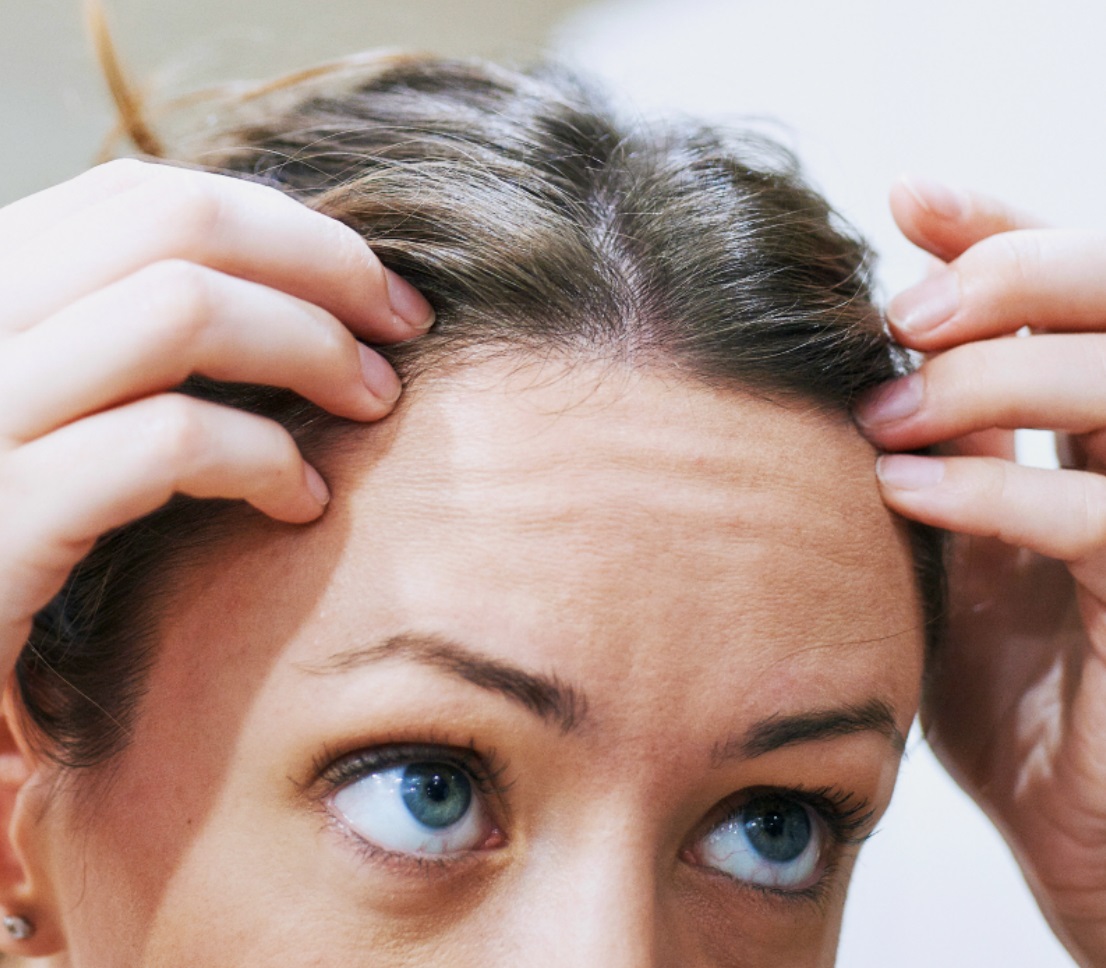  Menopause Hair Loss And Too Much Estrogen Annonce Vous