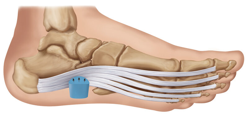 Popular Plantar Fasciitis Products