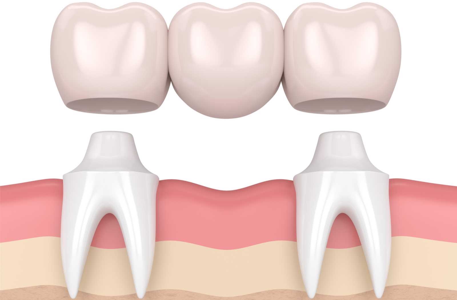 The Lifespan of Dental Bridges: Factors That Influence Longevity in Omaha