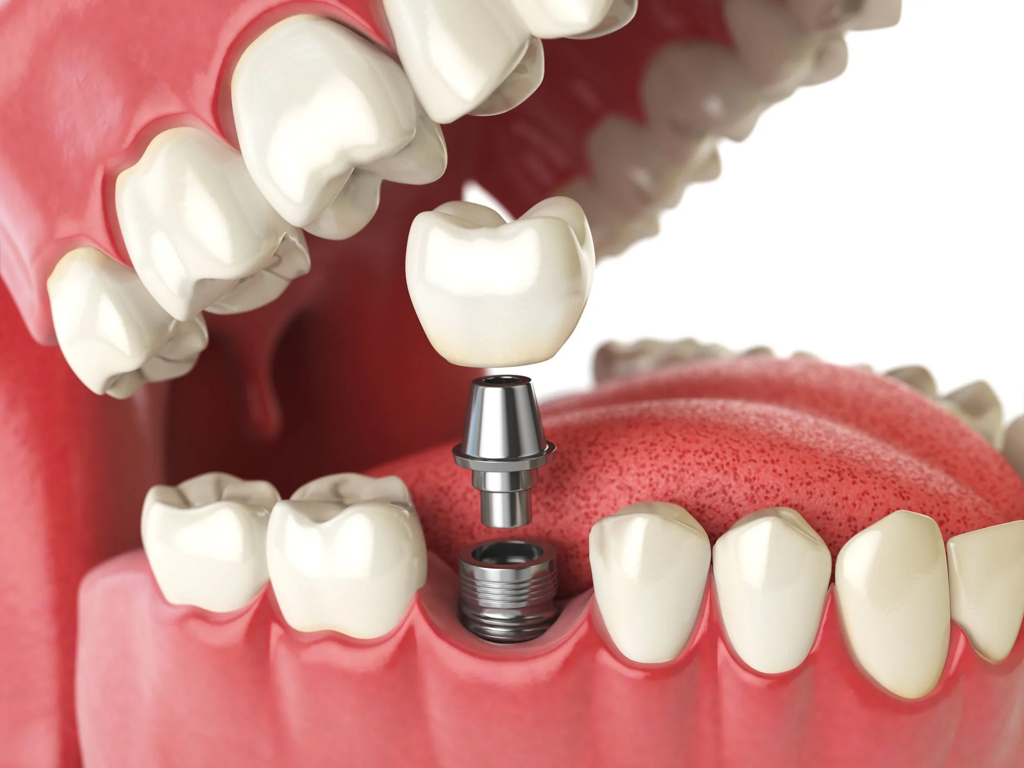 Implant vs. Bridge: Making the Right Choice for Tooth Replacement in Ottawa